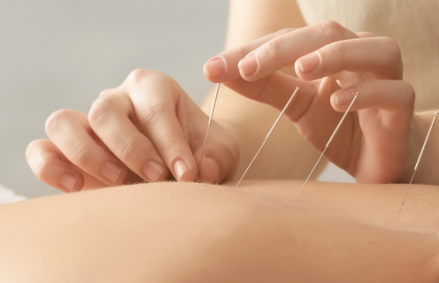 Restore Your Well-Being with TCM Acupuncture in Singapore