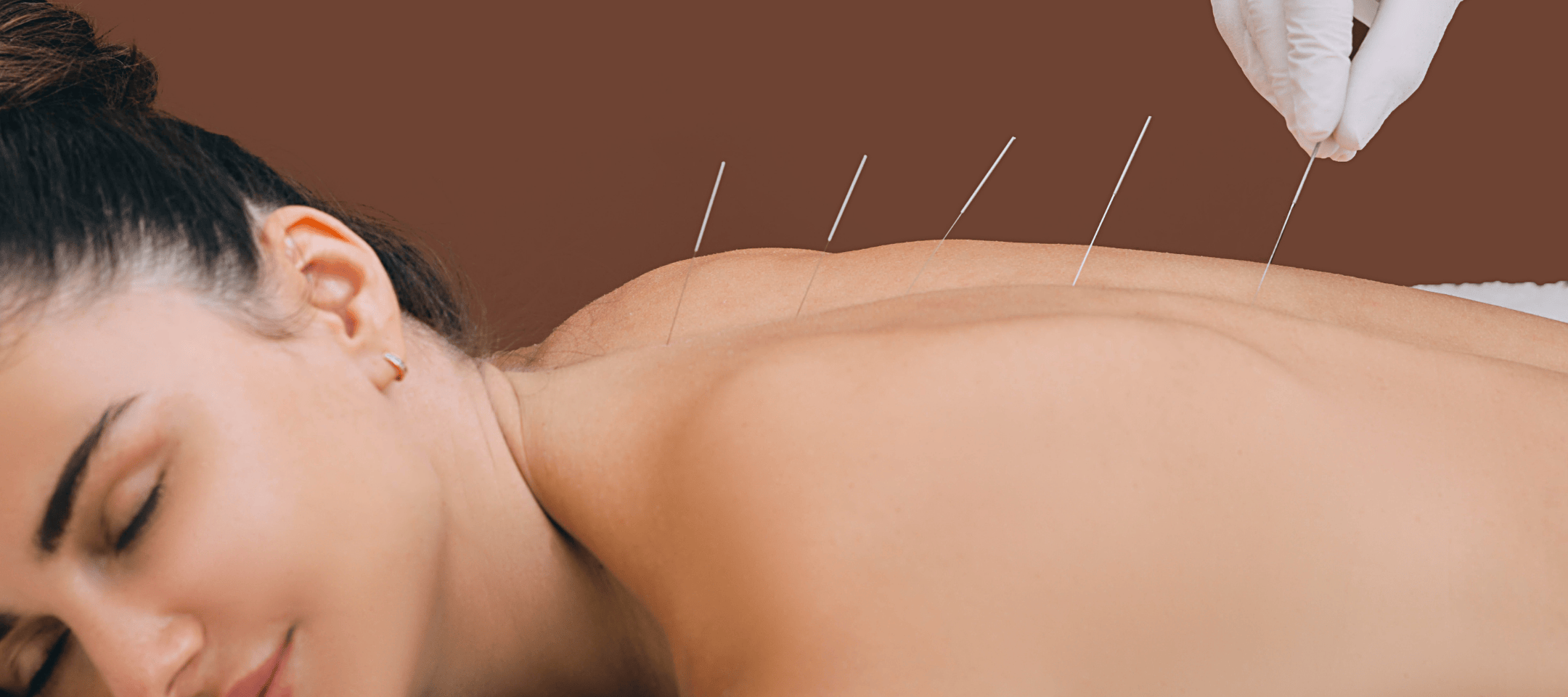 Acupuncture at Lao Niang TCM