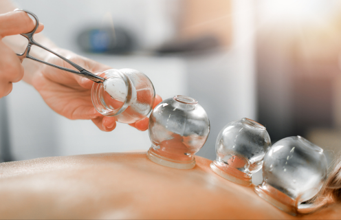 What is Cupping Therapy and How Does it Work?